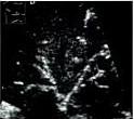 File:Air bronchogram by ultrasonography (Radiopaedia 12505).JPG