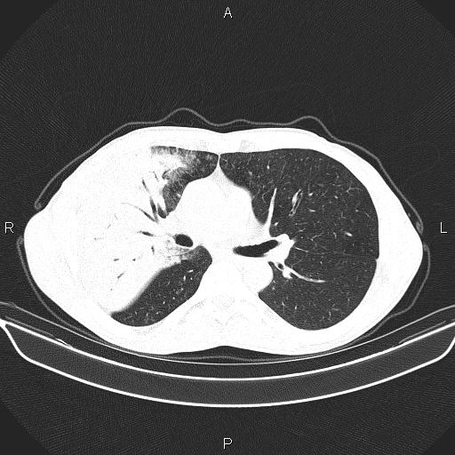 File:Air bronchogram in pneumonia (Radiopaedia 85719-101512 Axial lung window 31).jpg