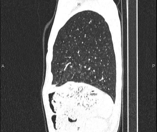 Air bronchogram in pneumonia (Radiopaedia 85719-101512 Sagittal lung window 80).jpg
