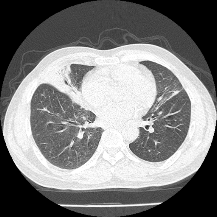 Airway foreign body in adult (Radiopaedia 85907-101779 Axial lung window 113).jpg