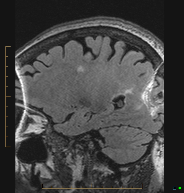 Aliasing artifact causing a spurious cerebellar lesion (Radiopaedia 48783-53810 Sagittal FLAIR 3).jpg