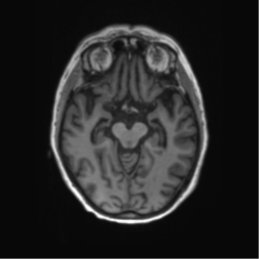 File:Alzheimer's disease (Radiopaedia 42658-45802 Axial T1 93).png