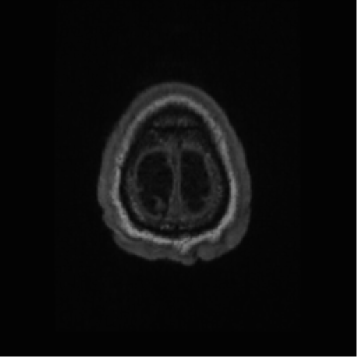 Alzheimer disease - probable (Radiopaedia 35334-36837 Axial T1 70).png