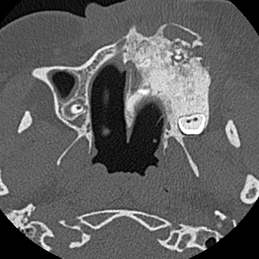 File:Ameloblastic fibro-odontoma (Radiopaedia 18843-18780 C 31).jpg