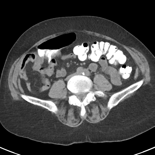 File:Ampullary adenocarcinoma (Radiopaedia 34013-35237 Axial non-contrast 38).png