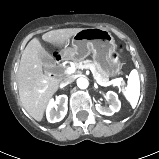 Ampullary adenocarcinoma (Radiopaedia 34013-35237 B 27).png