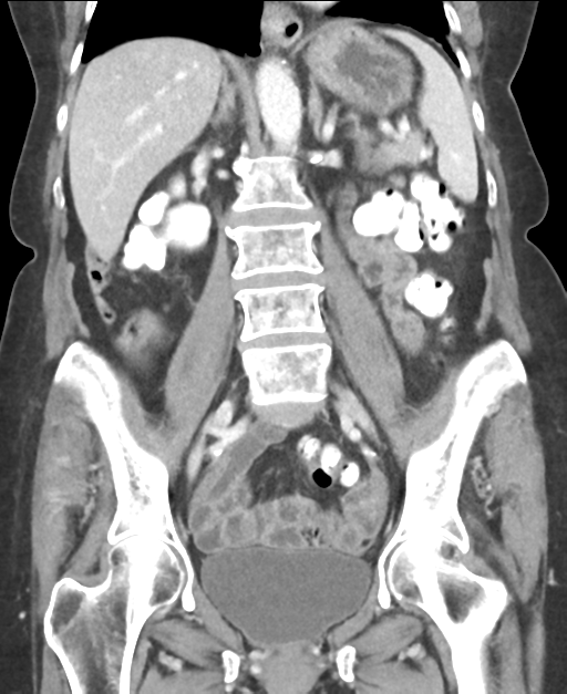 Ampullary adenocarcinoma (Radiopaedia 34013-35237 E 30).png