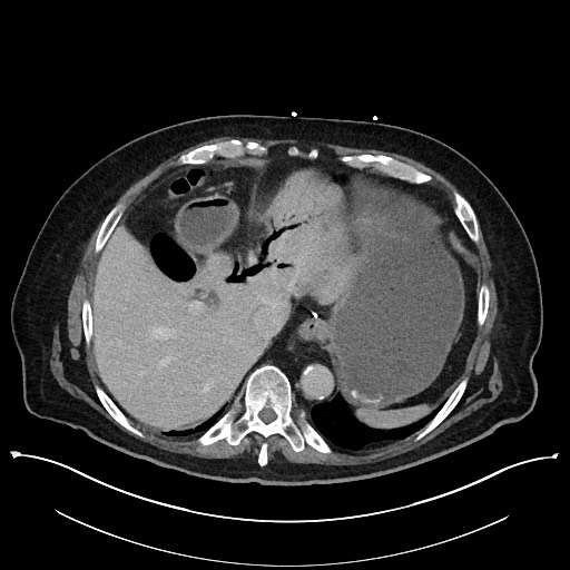 Ampullary adenocarcinoma (Radiopaedia 59373-66737 A 34).jpg