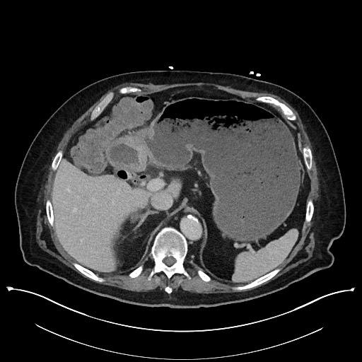 Ampullary adenocarcinoma (Radiopaedia 59373-66737 A 45).jpg