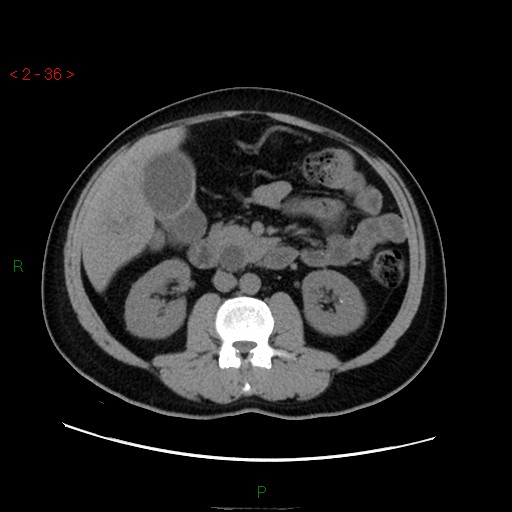File:Ampullary carcinoma (Radiopaedia 56396-63056 Axial non-contrast 24).jpg