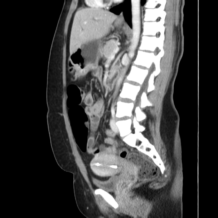 Ampullary tumor (Radiopaedia 22787-22816 D 31).jpg
