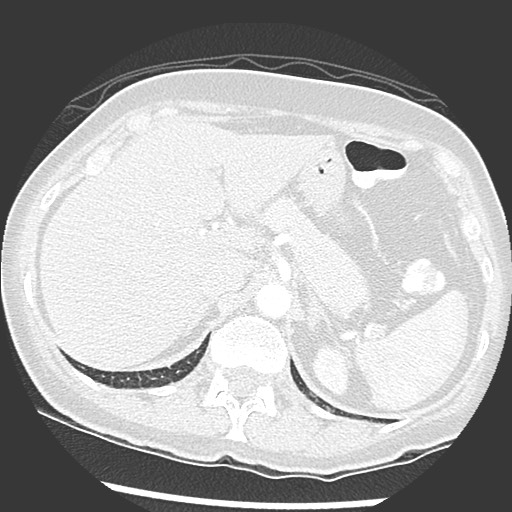 File:Amyloidosis - bronchial and diffuse nodular pulmonary involvement (Radiopaedia 60156-67745 Axial lung window 85).jpg