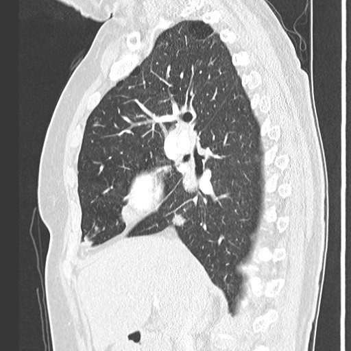 Amyloidosis - bronchial and diffuse nodular pulmonary involvement (Radiopaedia 60156-67745 Sagittal lung window 35).jpg