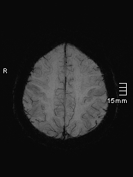 File:Amyotrophic lateral sclerosis (Radiopaedia 70821-81017 Axial SWI minIP 39).jpg