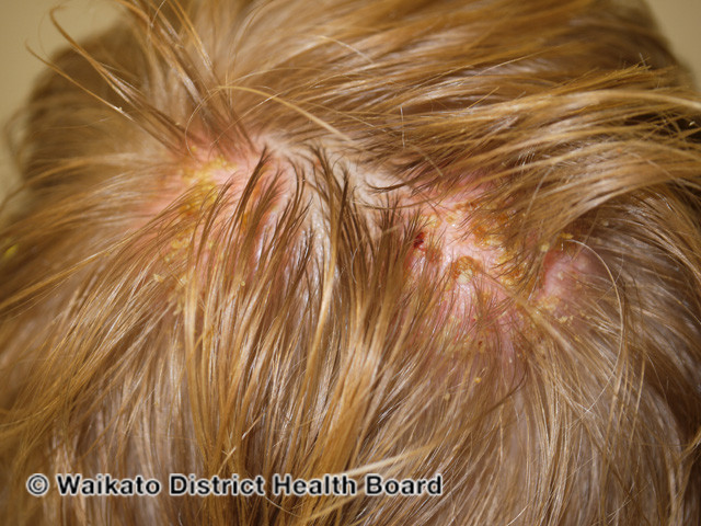 File:Anagen effluvium- fungal infection (kerion) (DermNet NZ hair-nails-sweat-w-anagen-effluvium-14).jpg