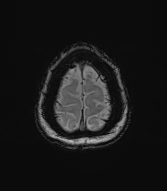 Anaplastic astrocytoma (Radiopaedia 86943-103160 Axial SWI 82).png