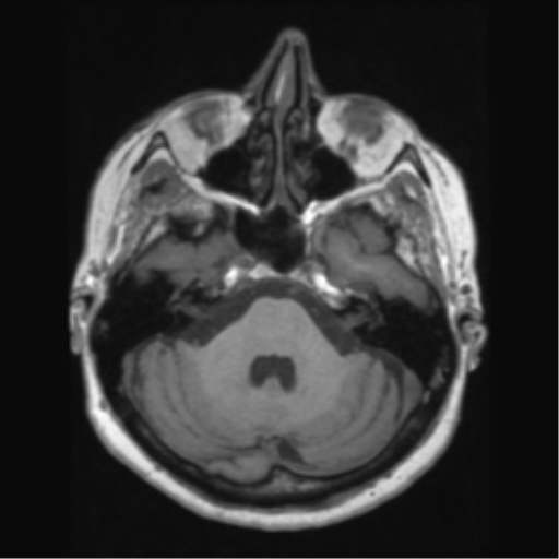 Anaplastic astrocytoma IDH wild-type (pseudoprogression) (Radiopaedia 42209-45276 Axial T1 45).png