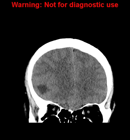 File:Anaplastic ganglioglioma (Radiopaedia 44921-48815 Coronal non-contrast 11).jpg