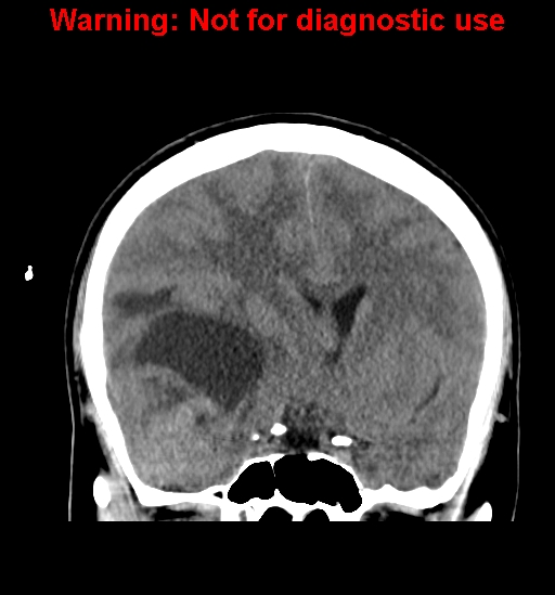 File:Anaplastic ganglioglioma (Radiopaedia 44921-48815 Coronal non-contrast 17).jpg