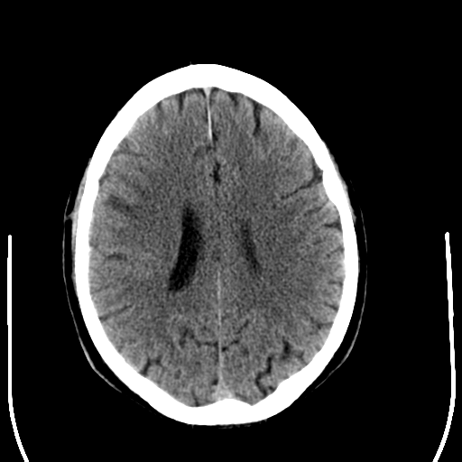 File:Anaplastic meningioma with recurrence (Radiopaedia 34452-35781 Axial non-contrast 22).png