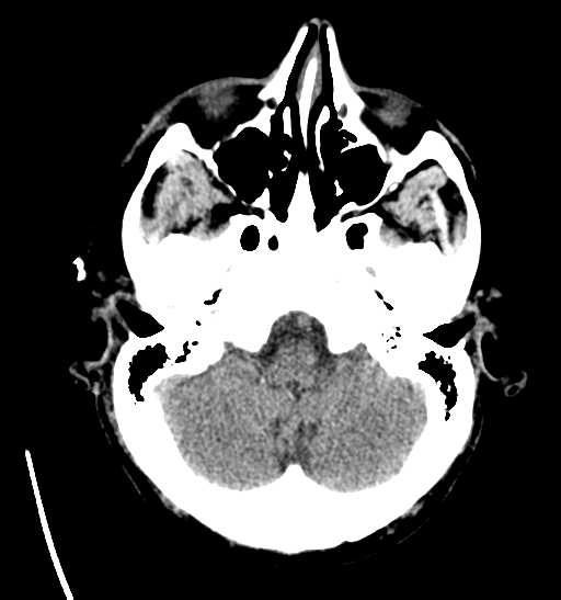 File:Anaplastic meningioma with recurrence (Radiopaedia 34452-35786 Axial non-contrast 7).png