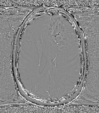 Anaplastic oligodendroglioma (Radiopaedia 83500-98599 Axial SWI - phase 54).png