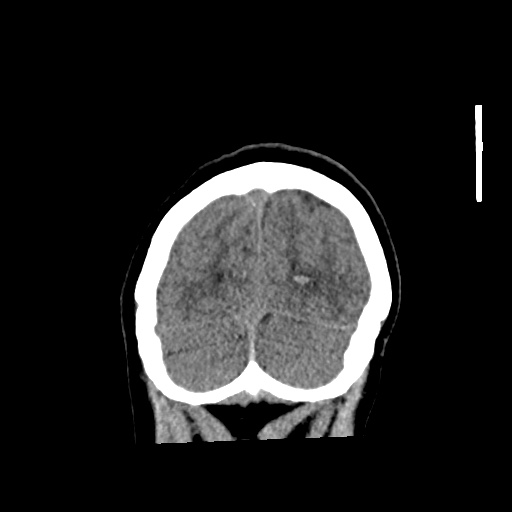 Aneursym related subarachnoid hemorrhage with hydrocephalus (Radiopaedia 45105-49083 Coronal non-contrast 58).jpg