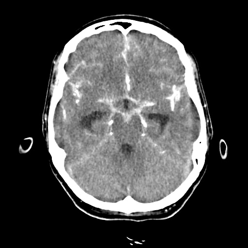 Aneursym related subarachnoid hemorrhage with hydrocephalus (Radiopaedia 45105-49084 D 19).jpg