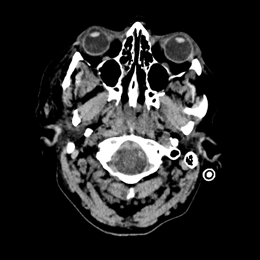 Aneursym related subarachnoid hemorrhage with hydrocephalus (Radiopaedia 45105-49085 Axial non-contrast 1).jpg