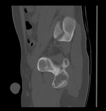 Aneurysmal bone cyst of ischium (Radiopaedia 25957-26094 Sagittal bone window 50).png