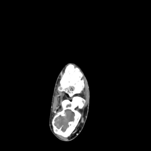 File:Aneurysmal bone cyst of the calcaneus (Radiopaedia 60669-68421 A 26).jpg