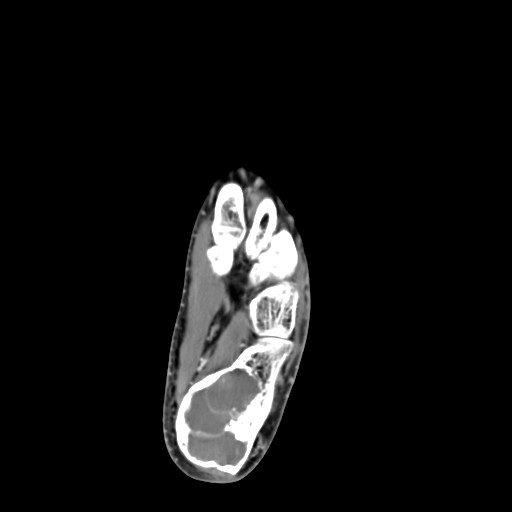 File:Aneurysmal bone cyst of the calcaneus (Radiopaedia 60669-68421 A 32).jpg
