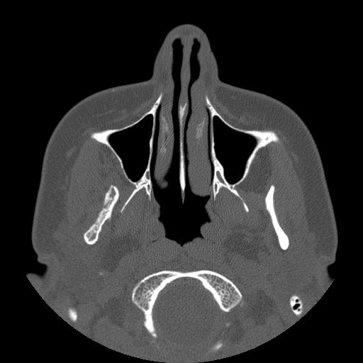 Aneurysmal bone cyst of the mandible (Radiopaedia 43280-46823 Axial bone window 112).jpg