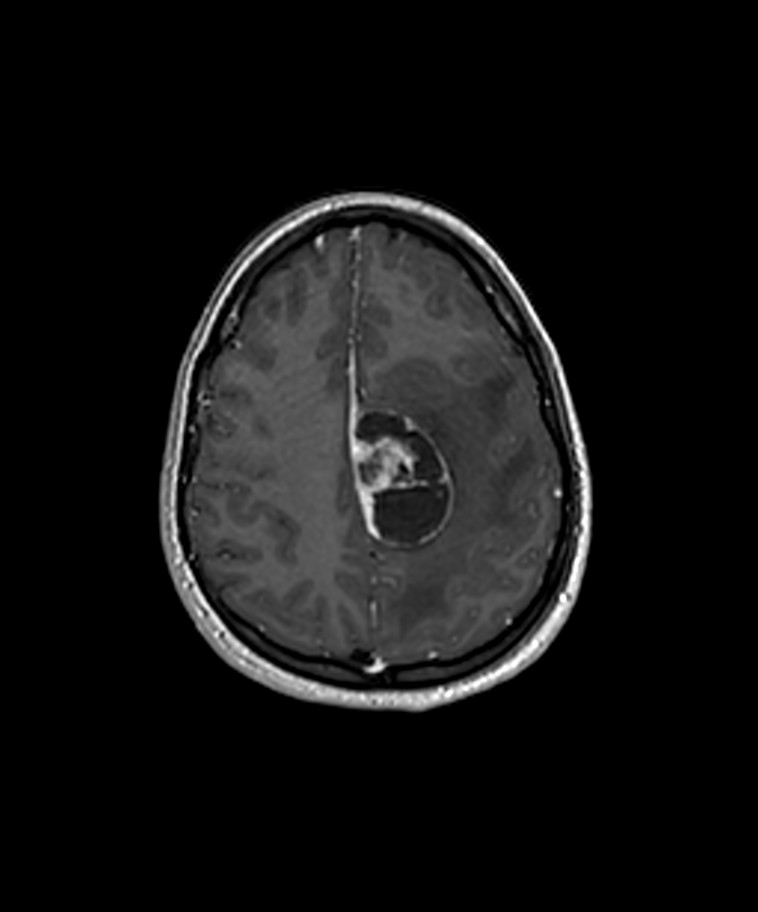 Angiomatous meningioma (Radiopaedia 79459-92577 Axial T1 C+ 3D ISO 35).jpg