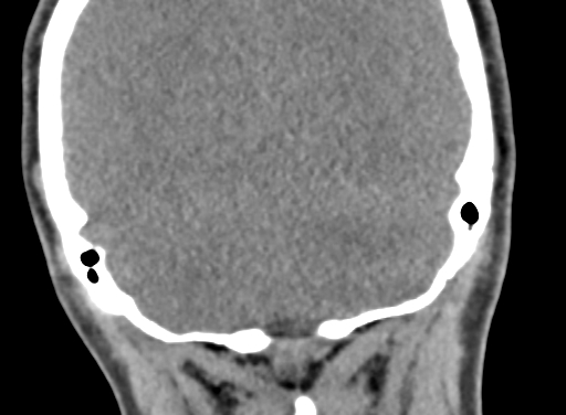 Angular dermoid cyst (Radiopaedia 88967-105790 Coronal non-contrast 102).jpg