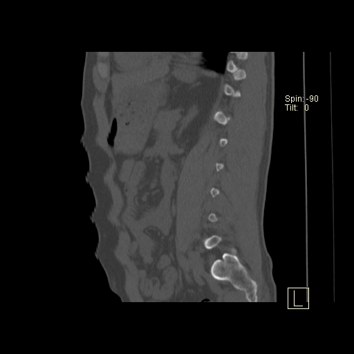 File:Ankylosing spondylitis (Radiopaedia 52728-58645 Sagittal bone window 2).jpg