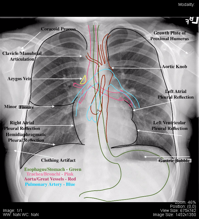 Annotated Normal Pediatric PA Chest x-ray.png