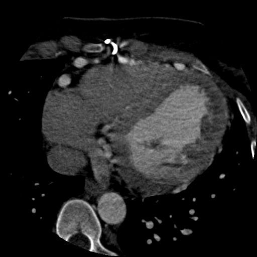 File:Anomalous left coronary artery from the pulmonary artery (ALCAPA) (Radiopaedia 40884-43586 A 60).jpg