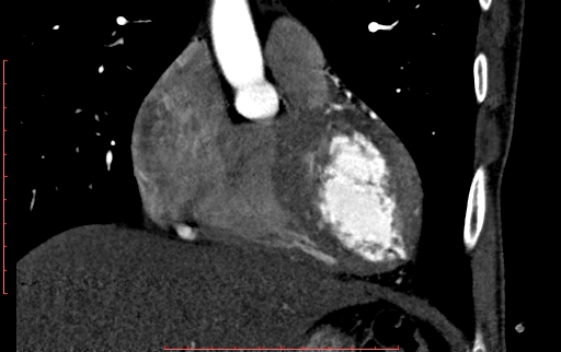 Anomalous left coronary artery from the pulmonary artery (ALCAPA) (Radiopaedia 70148-80181 B 101).jpg