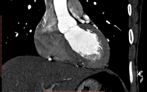 Anomalous left coronary artery from the pulmonary artery (ALCAPA) (Radiopaedia 70148-80181 B 132).jpg
