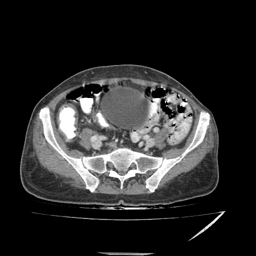 Anorectal carcinoma (Radiopaedia 44413-48064 A 40).jpg