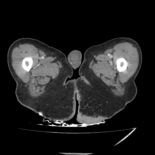 Anorectal carcinoma (Radiopaedia 44413-48064 A 70).jpg