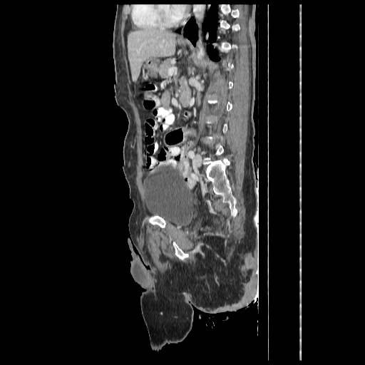 Anorectal carcinoma (Radiopaedia 44413-48064 C 64).jpg