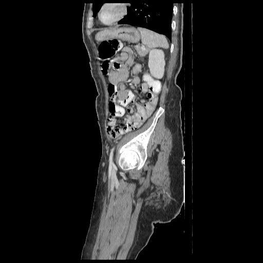 File:Anorectal carcinoma (Radiopaedia 44413-48064 C 86).jpg