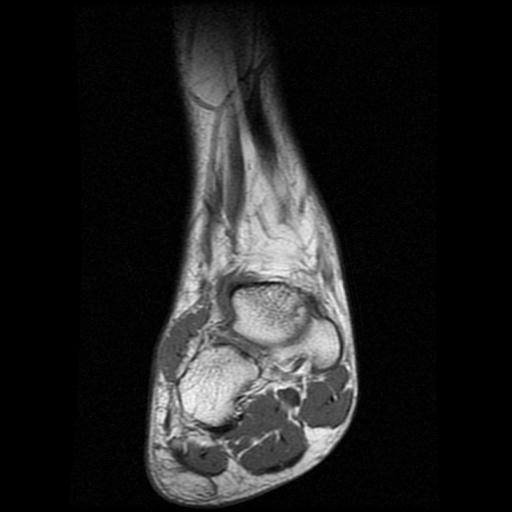 File:Anterior calcaneal process fracture (Radiopaedia 71377-81705 Coronal T1 3).jpg