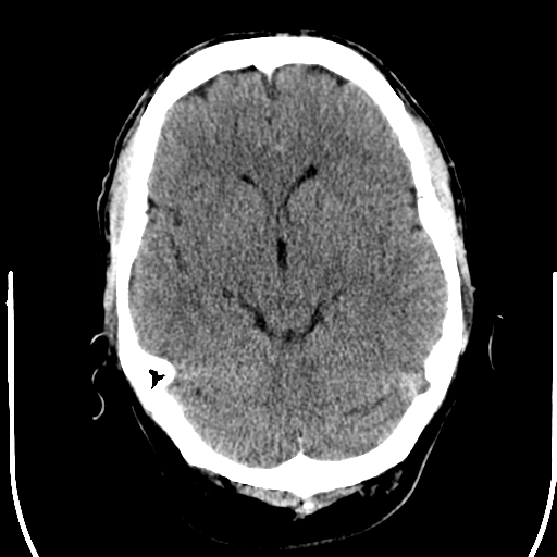 File:Anterior cerebral artery territory infarct (Radiopaedia 39327-41581 Axial non-contrast 11).png