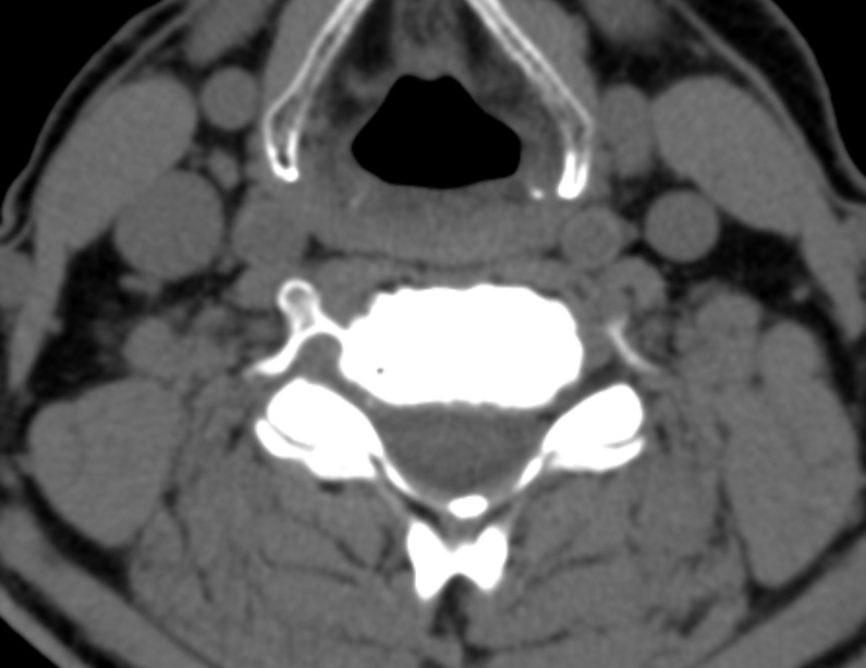 Anterior cervical postdiscectomy arthrodesis (Radiopaedia 32678-33646 Axial non-contrast 45).jpg