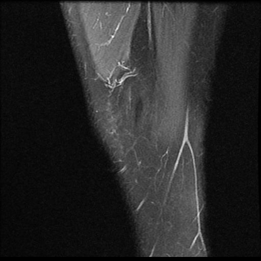 File:Anterior cruciate ligament avulsion fracture (Radiopaedia 58939-66193 Sagittal PD fat sat 21).jpg