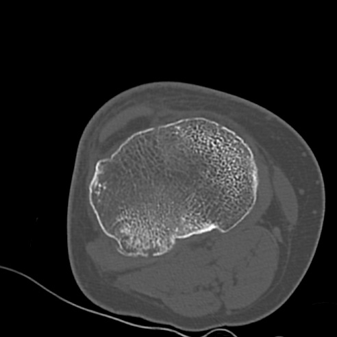 File:Anterior cruciate ligament avulsion fracture (Radiopaedia 58939-66194 Axial bone window 22).jpg