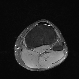 File:Anterior cruciate ligament full thickness tear (Radiopaedia 66268-75467 Axial PD fat sat 25).jpg